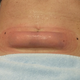 Image for article titled You Can Freeze Your Fat and Poop It Out